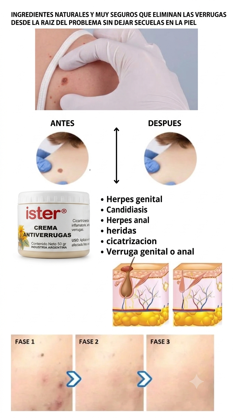 Ingredientes naturales y muy seguros que eliminan las verrugas desde la raiz del problema